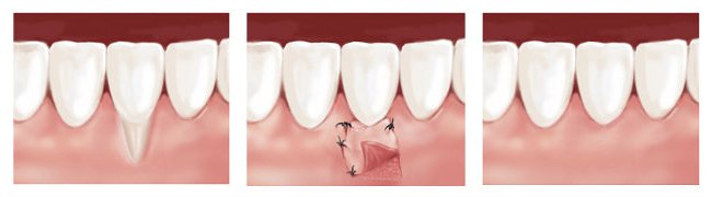 Periodoncia Encías Retraídas - Tratamientos | Santa Perpetua Clínica Dental